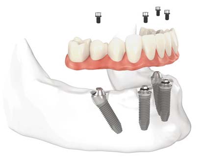 All On 4 Hybrid Dentures